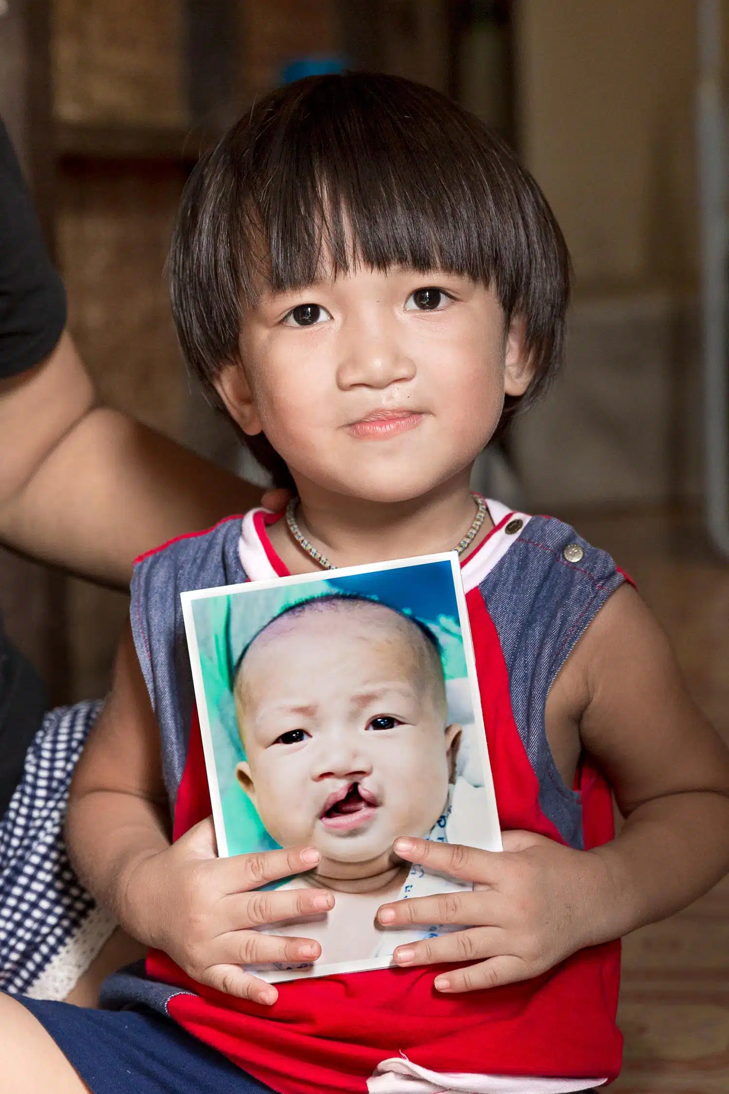 An Operation Smile patient posing with a photo of himself before cleft surgery